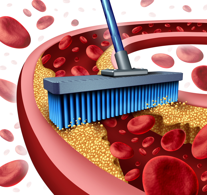 Cleaning arteries concept as a broom removing plaque buildup in a clogged artery as a symbol of atherosclerosis disease medical treatment opening clogged veinsÊwith blood cells as a metaphor for removing cholesterol as an icon of vascular diseases.